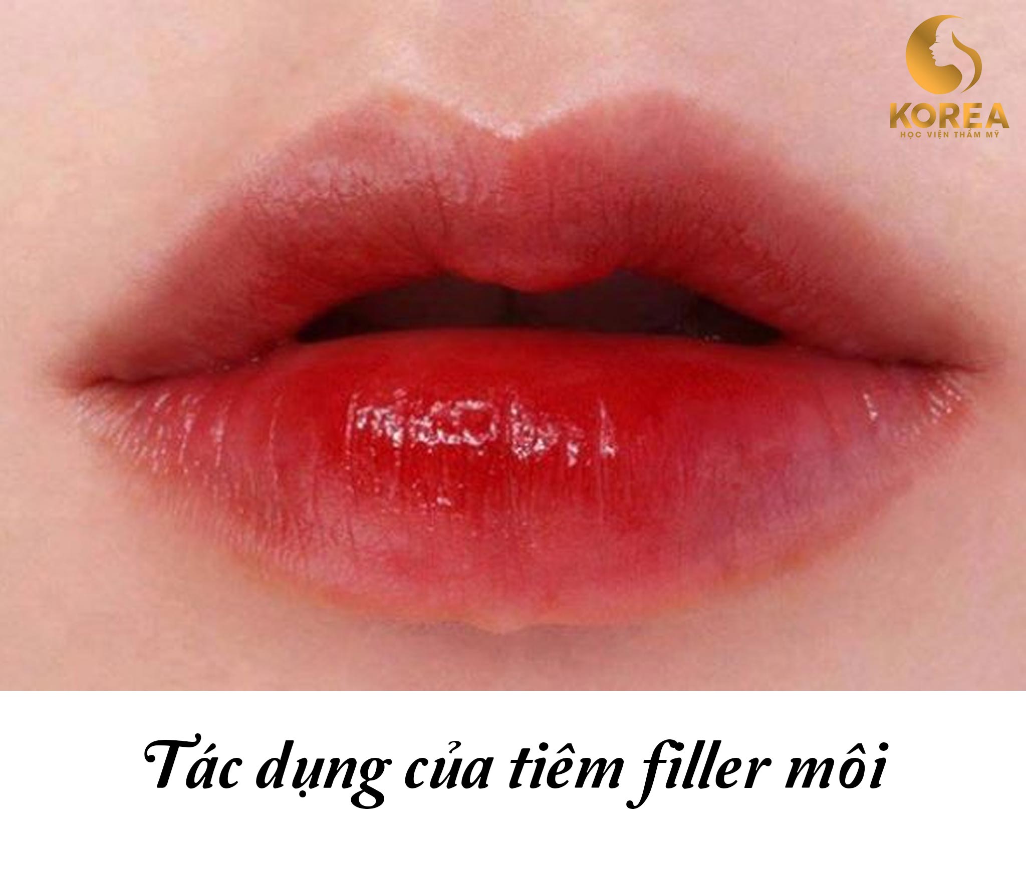 TIÊM FILLER MÔI CÓ NHỮNG TÁC DỤNG GÌ